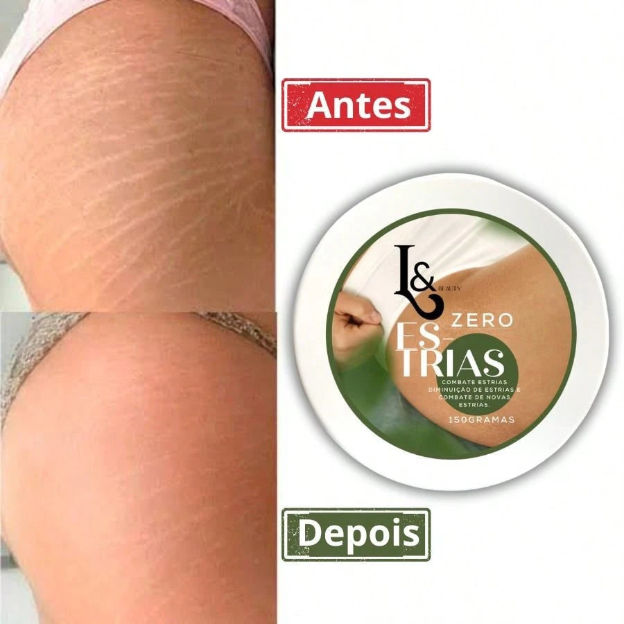 Creme Zero Estrias Removedor Anti Estrias Trata E Previne 150g - L&Beauty